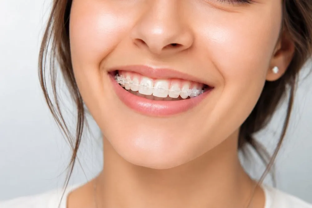 brackets de zafiro_Clinica Ronald_cluster